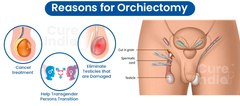 Reasons for Orchiectomy Surgery in India